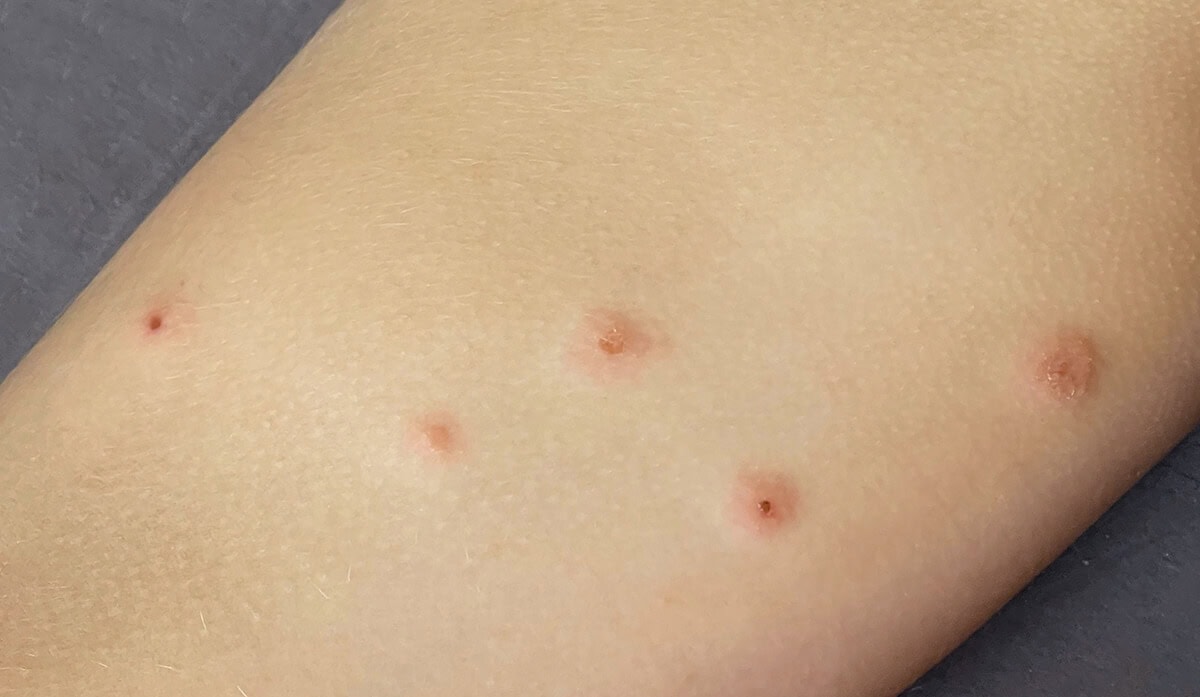 How big are bed bug bites